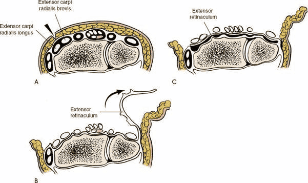 Figure 5-4 A: For synovectomy, make an incision over the second compartment. B: Open each of the compartments sequentially from radius to ulna by incising the septum that connects the retinaculum to the carpus itself and the joint capsule. C: Now that the compartments have been deroofed, place the retinaculum between the extensor tendons and the distal ends of the radius and ulna to provide added protection for the tendons.
