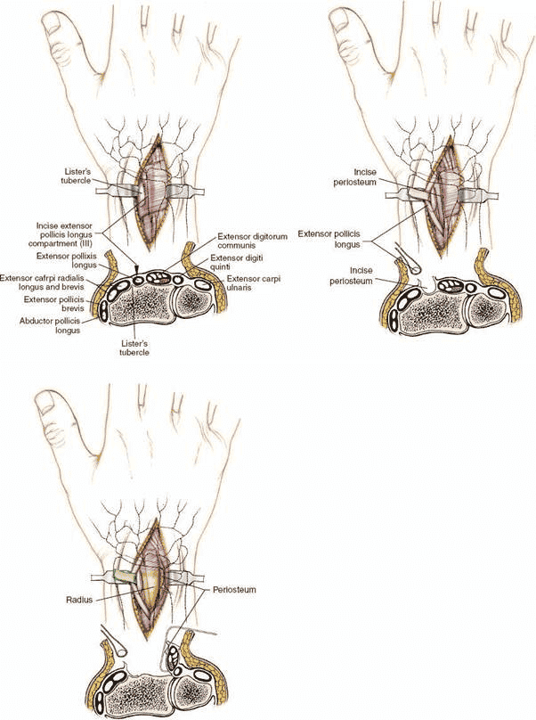 re 5-5 Enter the wrist joint by making a small transverse incision in the wrist joint capsule. The intermediate column of the distal radius and the lunate are exposed.