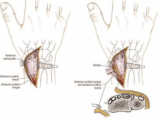 Figure 5-6 Retract the tendons of extensor pollicis brevis and abductor pollicislongus radially to expose the radial column of the distal radius.