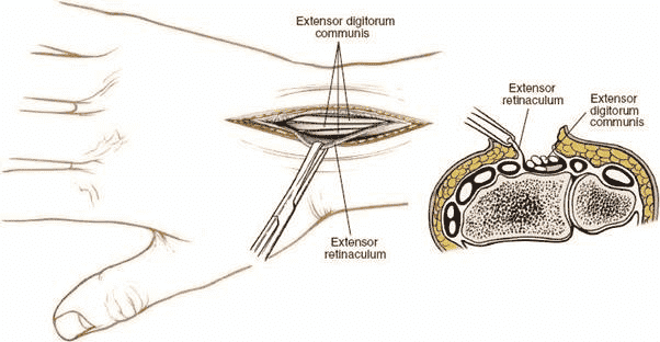 Figure  5-7  The  retinaculum  over  the  fourth  compartment  has  been  opened, revealing the communis tendons.