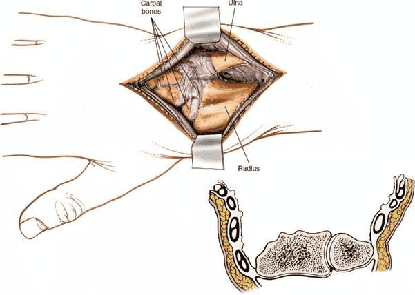 Figure 5-10 The extensor tendons in their compartments have been elevated to expose the distal end of the radius and ulna.