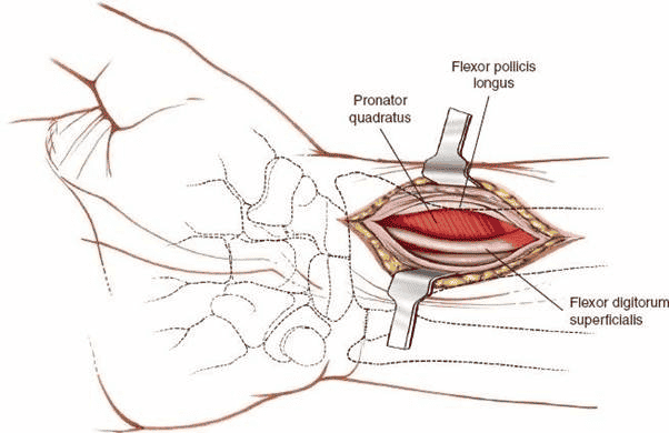 Figure 5-18 The tendon of flexor carpi radialis is retraced ulnarly to reveal the pronator quadratus muscle.