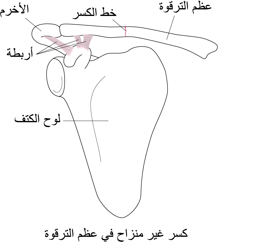 كسر الترقوة