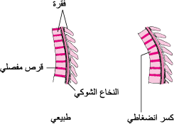 الكُسُورُ الانضِغاطية في العمود الفقري