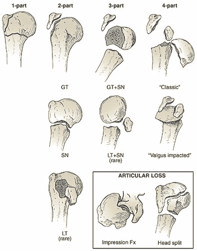 Orthopedic MD Oral Examination:Management of Proximal Humerus Fracture