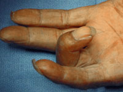 مرض الإصبع المشنوق