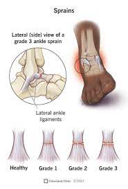 ankle twist grades