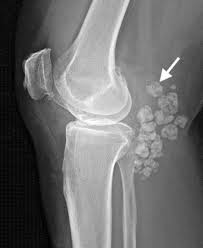 Synovial Chondromatosis knee