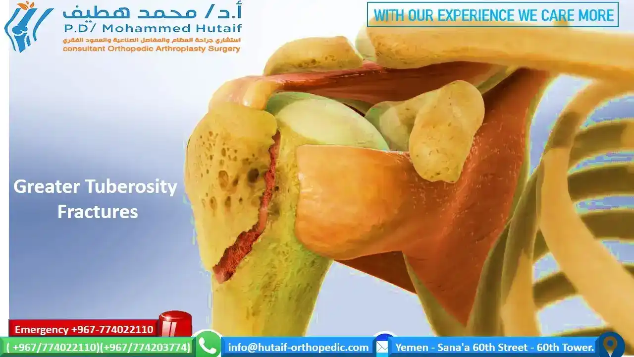 X-ray of greater tuberosity fracture