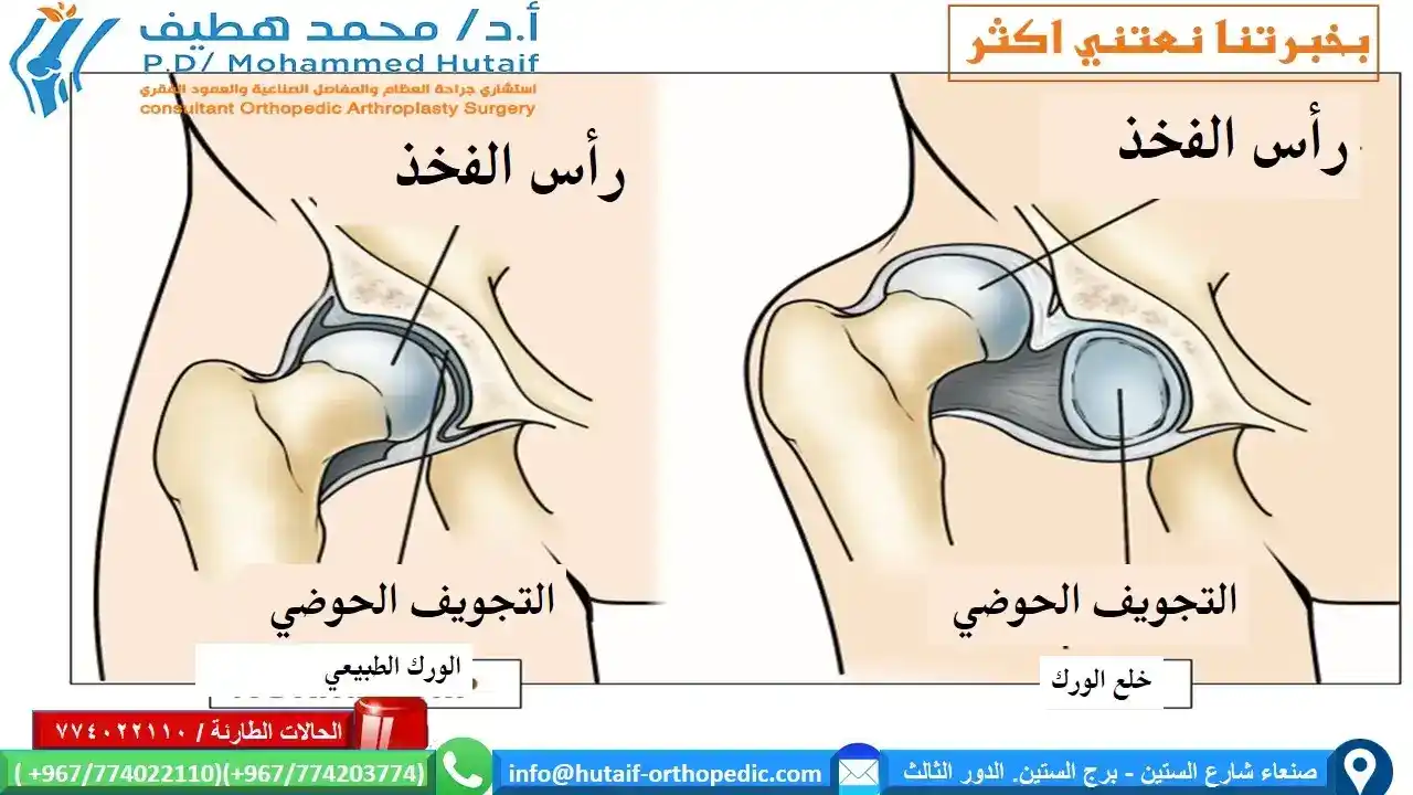 تجاربكم مع خلع الورك