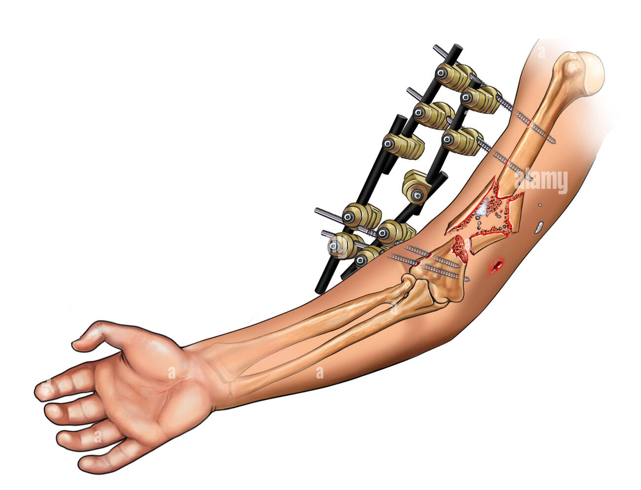 External Fixation Of The Humerus Safe Pin Placement And Techniques 0570