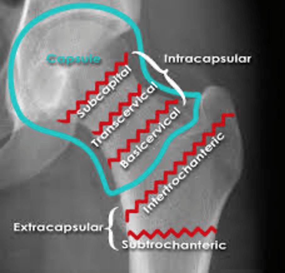 Subcapital Femoral Neck Fracture