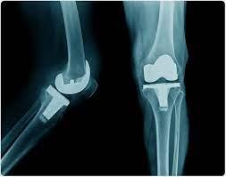 15 Knee Replacement Patient Stories and Reviews