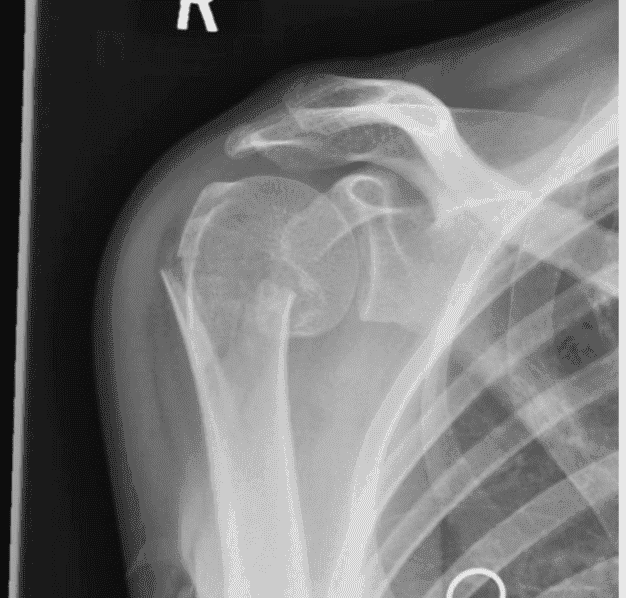 Orthopedic MD Oral Examination:Management of Proximal Humerus Fracture