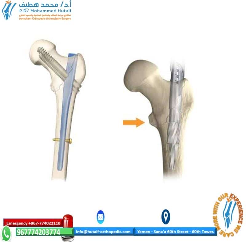 Controlled study on Gamma nail and proximal femoral locking plate for  unstable intertrochanteric femoral fractures with broken lateral wall |  Scientific Reports