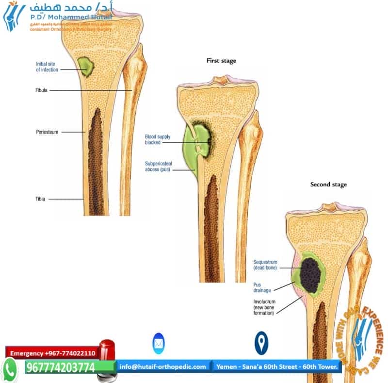 Fracture-Related Infection of the tibia due to a polymicrobial