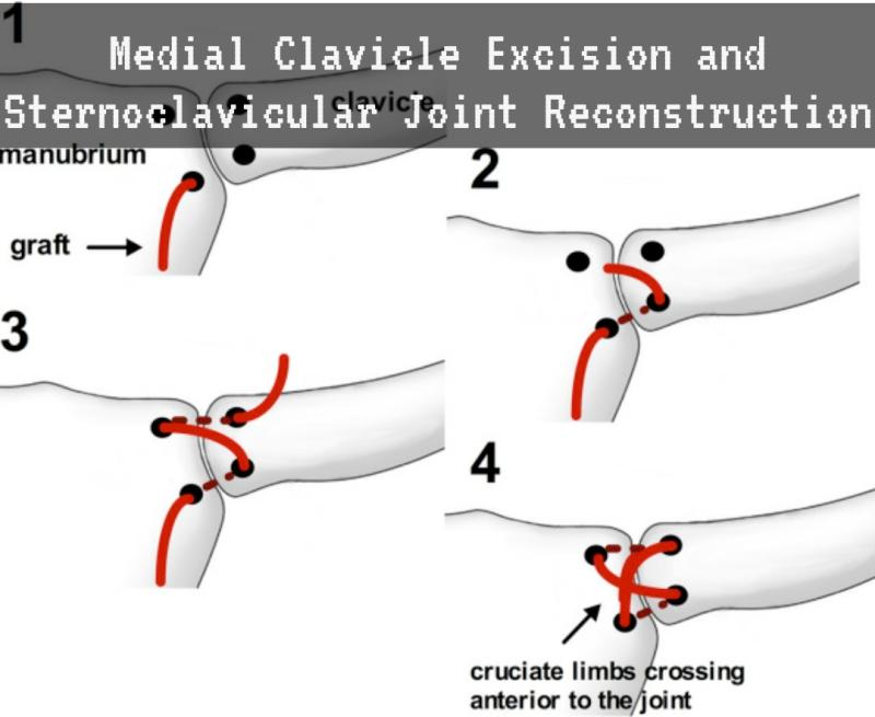 Medial Clavicle Excision and Sternoclavicular Joint Reconstruction